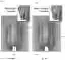 Fig. 14 - FORESKIN MANIPULATOR