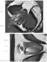 Fig. 18 - FORESKIN MANIPULATOR