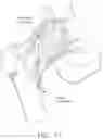 Fig. 12 - METHOD AND APPARATUS FOR ATTACHING TISSUE TO BONE, INCLUDING THE PROVISION AND USE OF A NOVEL KNOTLESS SUTURE ANCHOR SYSTEM