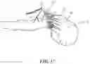 Fig. 18 - DEVICES, SYSTEMS, AND METHODS FOR MINIMALLY INVASIVE MODULATION OF ABDOMINAL TISSUE
