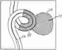 Fig. 01 - VASO-OCCLUSIVE DEVICES INCLUDING A FRICTION ELEMENT