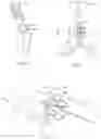 Fig. 06 - Medical device and system for occluding a tissue opening and method thereof