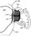 Fig. 01 - Occluding anatomical structures