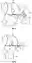 Fig. 06 - Tibial cutting guide assemblies and associated instrumentation for performing surgical methods