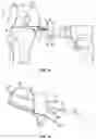 Fig. 11 - Tibial cutting guide assemblies and associated instrumentation for performing surgical methods