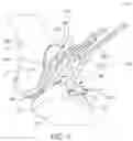 Fig. 04 - Tibial guide transfer instruments and methods