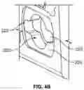 Fig. 05 - Minimally invasive surgery targeting guides and methods of use
