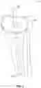 Fig. 04 - Tensor device for revision knee arthroplasty