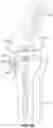 Fig. 06 - Tensor device for revision knee arthroplasty