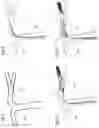 Fig. 05 - Clot engagement and removal system