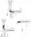 Fig. 06 - Clot engagement and removal system