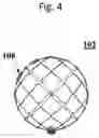 Fig. 05 - STENT RETRIEVER WITH EMBOLIC PREVENTION DEVICE