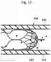 Fig. 12 - STENT RETRIEVER WITH EMBOLIC PREVENTION DEVICE
