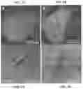 Fig. 13 - APPARATUSES, SYSTEMS AND METHODS FOR PERFORATING AND ASPIRATING INNER EAR