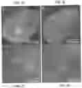 Fig. 14 - APPARATUSES, SYSTEMS AND METHODS FOR PERFORATING AND ASPIRATING INNER EAR