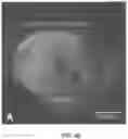 Fig. 20 - APPARATUSES, SYSTEMS AND METHODS FOR PERFORATING AND ASPIRATING INNER EAR