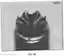 Fig. 35 - APPARATUSES, SYSTEMS AND METHODS FOR PERFORATING AND ASPIRATING INNER EAR