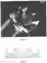 Fig. 36 - APPARATUSES, SYSTEMS AND METHODS FOR PERFORATING AND ASPIRATING INNER EAR