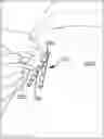 Fig. 01 - Directional device for epidural needle