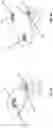 Fig. 04 - Systems and methods for treating rib fractures and osteotomies using implantation