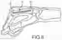 Fig. 07 - BONE STABILIZATION DEVICE