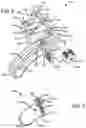 Fig. 05 - METATARSAL ALIGNMENT APPARATUS