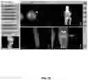 Fig. 77 - System and method for providing surgical planning and guidance with three-dimensional visualization