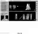 Fig. 79 - System and method for providing surgical planning and guidance with three-dimensional visualization