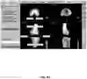 Fig. 84 - System and method for providing surgical planning and guidance with three-dimensional visualization