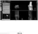 Fig. 93 - System and method for providing surgical planning and guidance with three-dimensional visualization