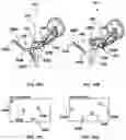 Fig. 16 - SURGICAL ROBOTIC AUTOMATION WITH TRACKING MARKERS AND CONTROLLED TOOL ADVANCEMENT