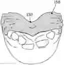 Fig. 01 - Palatal expanders and methods of forming the same