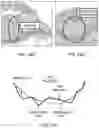 Fig. 17 - Palatal expanders and methods of forming the same