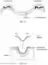 Fig. 46 - Palatal expanders and methods of forming the same