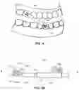 Fig. 04 - Force applying device for orthodontic treatment