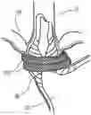 Fig. 01 - METHODS AND DEVICES FOR TREATING SPHINCTER DISORDERS