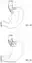 Fig. 02 - METHODS AND DEVICES FOR TREATING SPHINCTER DISORDERS