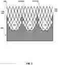 Fig. 03 - Transcatheter heart valve prostheses