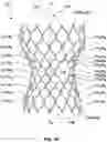 Fig. 04 - Transcatheter heart valve prostheses