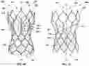 Fig. 14 - Transcatheter heart valve prostheses