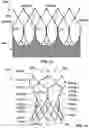 Fig. 19 - Transcatheter heart valve prostheses