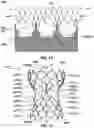 Fig. 22 - Transcatheter heart valve prostheses