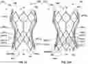 Fig. 28 - Transcatheter heart valve prostheses