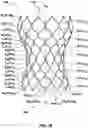 Fig. 31 - Transcatheter heart valve prostheses