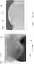Fig. 28 - FLARED PROSTHETIC CARDIAC VALVE DELIVERY DEVICES AND SYSTEMS