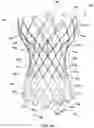 Fig. 02 - Transcatheter heart valve prosthesis systems and methods for rotational alignment