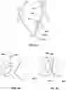 Fig. 12 - Transcatheter heart valve prosthesis systems and methods for rotational alignment