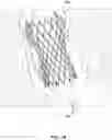 Fig. 14 - Transcatheter heart valve prosthesis systems and methods for rotational alignment