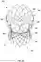 Fig. 35 - Transcatheter heart valve prosthesis systems and methods for rotational alignment