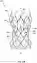 Fig. 45 - Transcatheter heart valve prosthesis systems and methods for rotational alignment